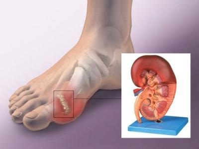 Gout còn được gọi l